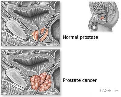 prostrate cancer