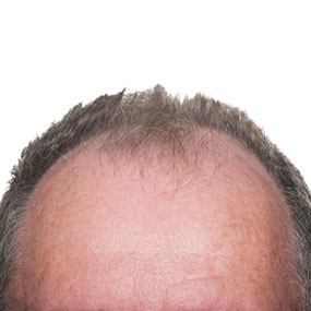 male pattern baldness and testosterone