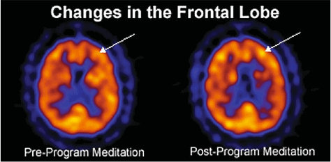 The frontal lobes exhibit increased cerebral blood flow after Kirtan Kriya Meditation.