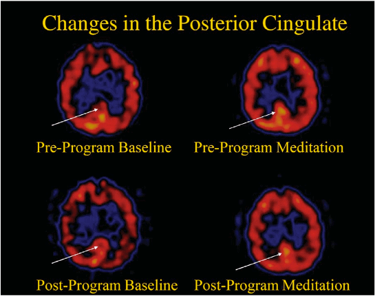 The posterior cingulate gyrus (PCG) is activated by Kirtan Kriya Meditation.