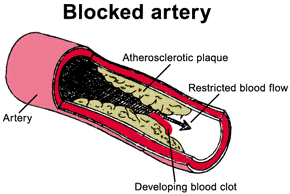 blocked-artery