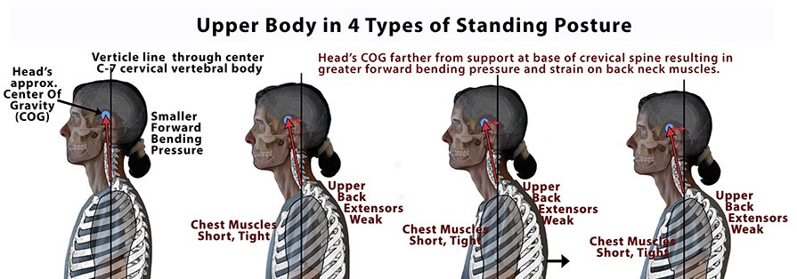 Proper alignment improves neck arthritis symptoms