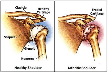 You can beat shoulder arthritis