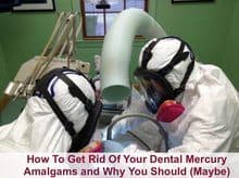 dental mercury amalgams