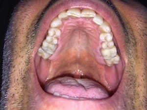 dental mercury amalgams