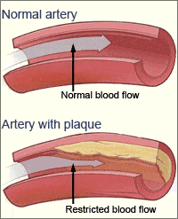 Symptoms of arterial plaque