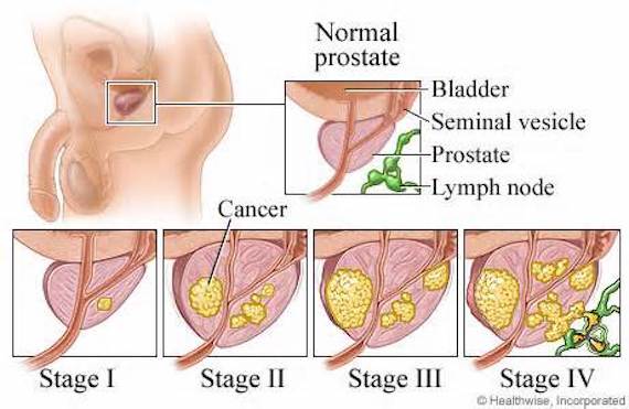 Prevent prostate cancer with diet by eating plant food,