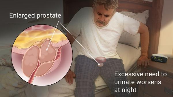 Enlarged prostate and diet