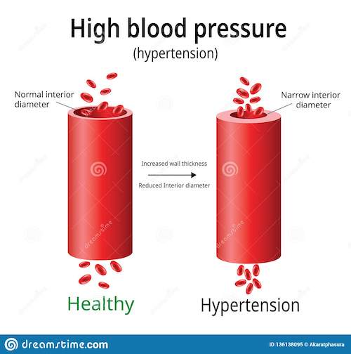 salt substitute for high blood pressure