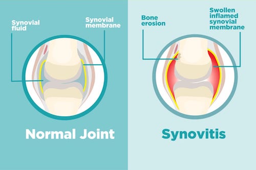 Common treatments for joint pain
