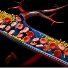 apoB level has a causal association with atherosclerosis.