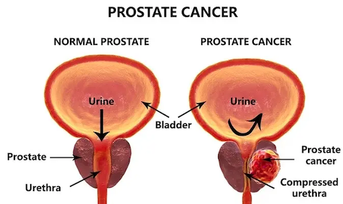 Prostate and Heart health