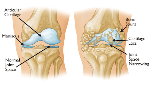 how osteoarthritis happens
